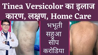 Tinea Versicolar Treatment  भभूतीसीपसहुआकरोडिया का इलाज  Pityriasis Versicolor  In Hindi [upl. by Marmion905]